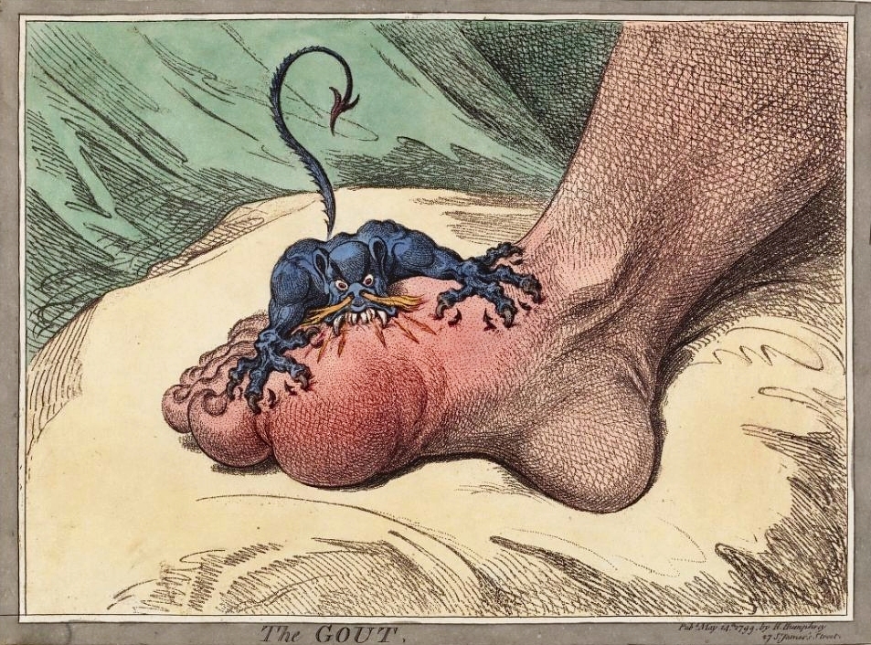 James Gillray's The Gout, showing a creature biting an inflamed foot